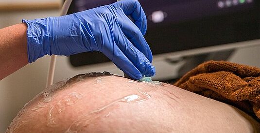 afbeelding Bloedverlies in de zwangerschap